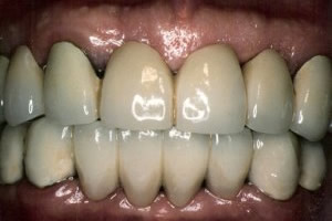 Advanced periodontal disease - after